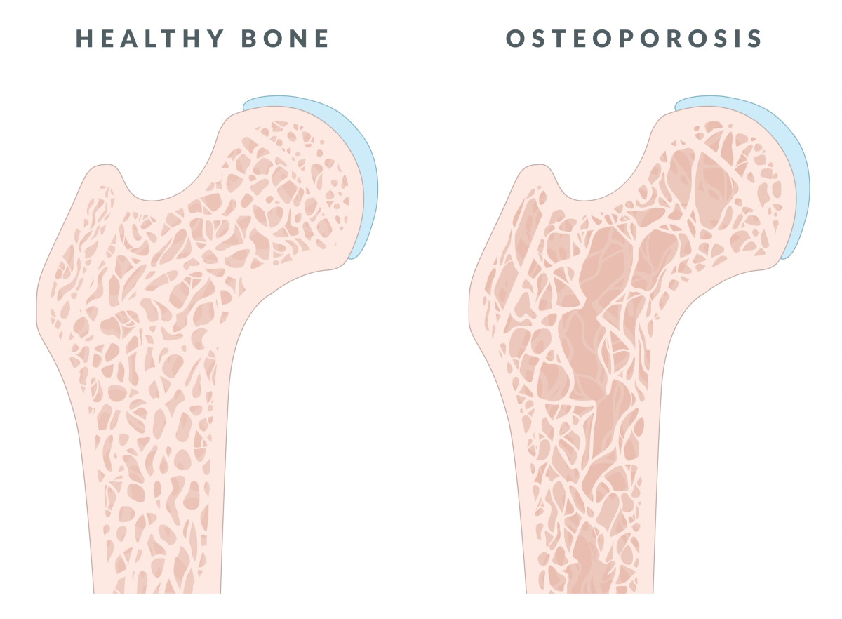 Osteoporosis, Rheumatoid Arthritis, and Women: Knowledge Is Power - The ...